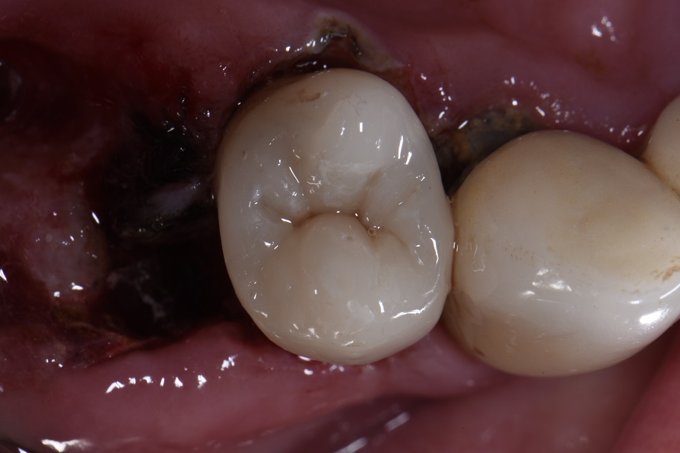 Complex Reconstruction of Near-Hopeless Teeth