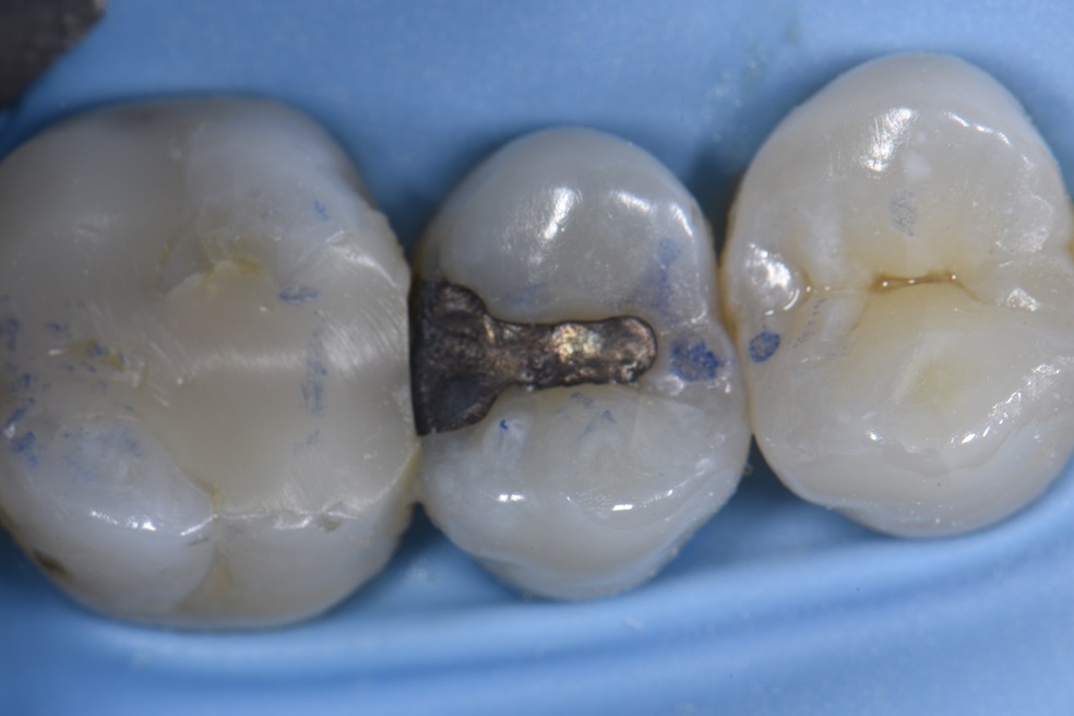 Amalgam Replacements with a Beautiful Composite Resin