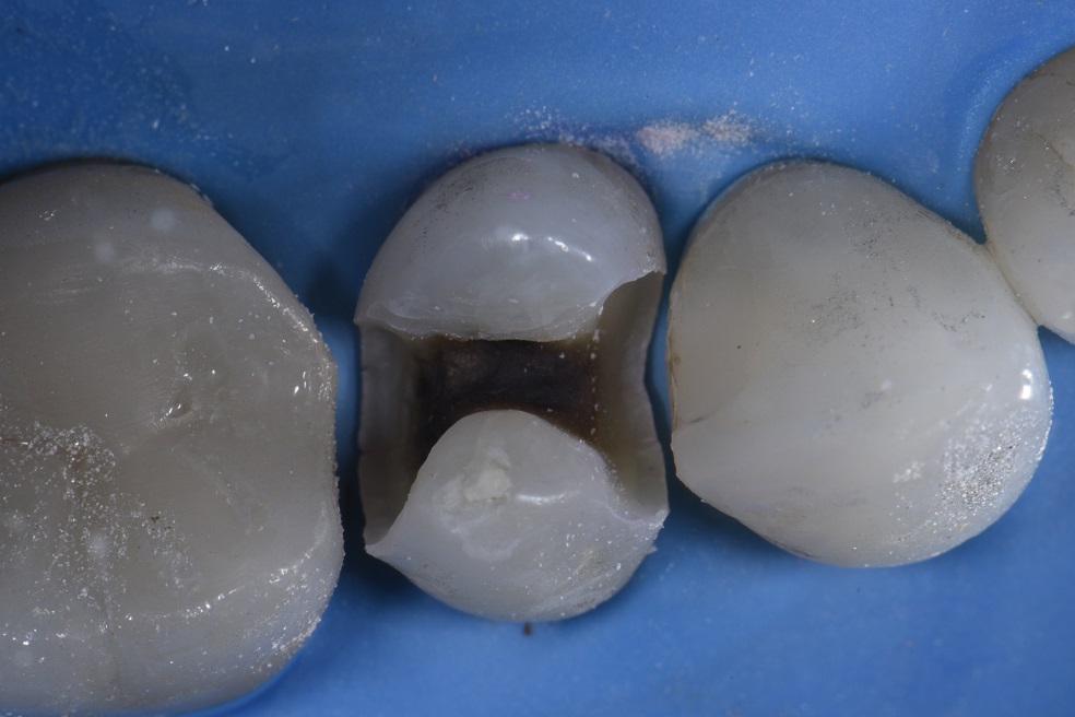 Amalgam restored teeth transformed to virgin appearance