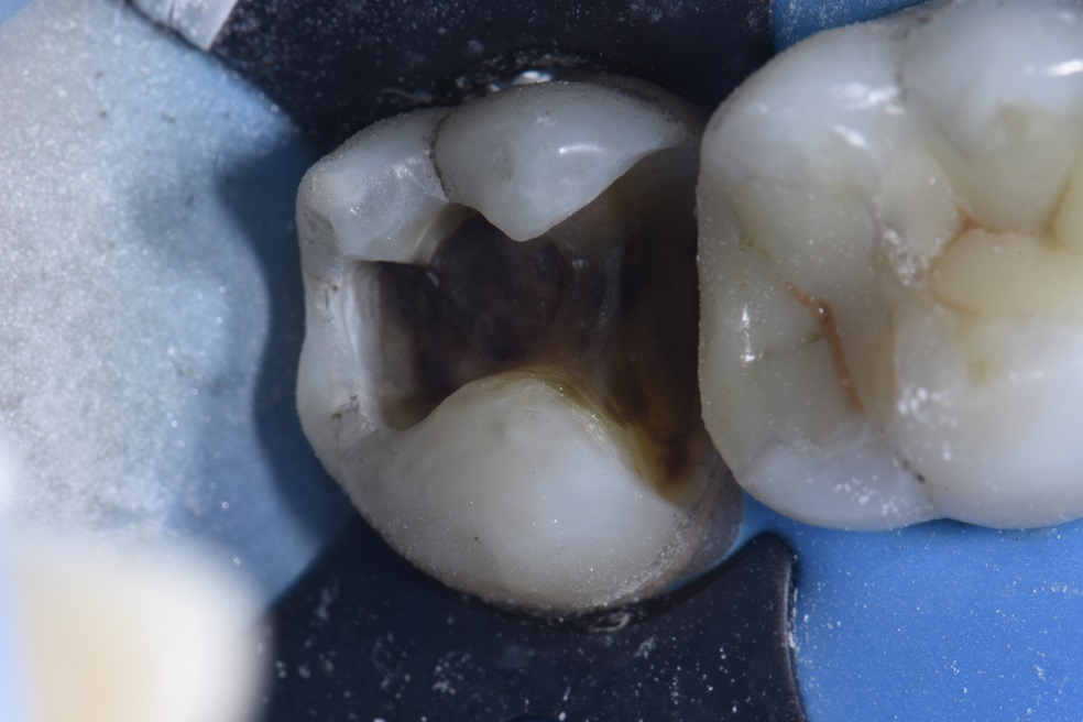 Blocking out dark amalgam staining with composite resin