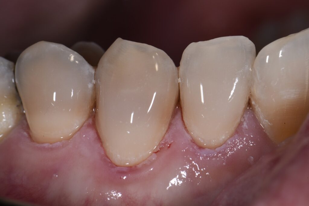 Non-invasive resin bonding on tetracycline stained teeth Non-invasive resin bonding on tetracycline stained teeth