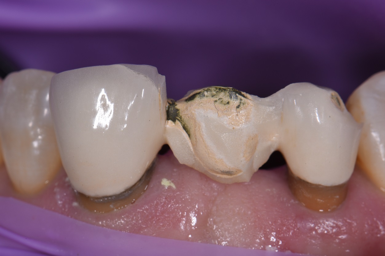 Ovate Pontic Site Development