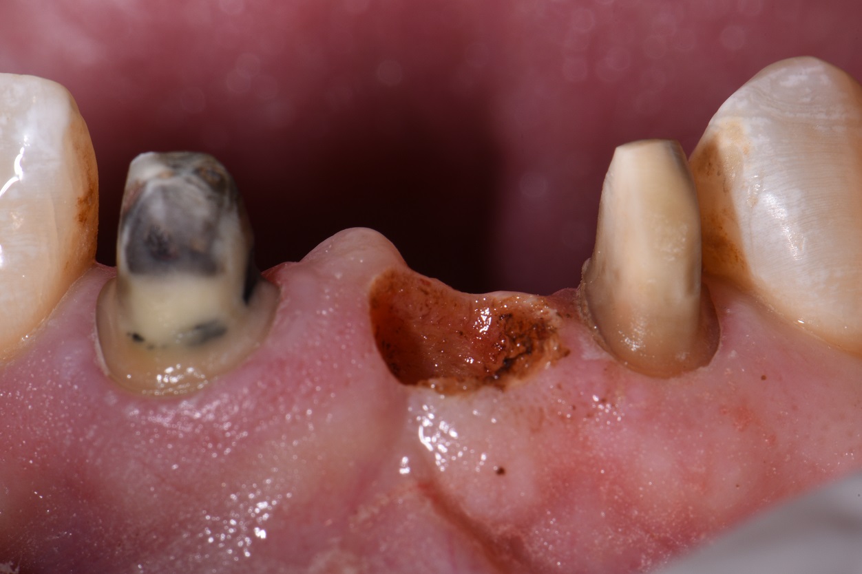 Ovate Pontic Site Development