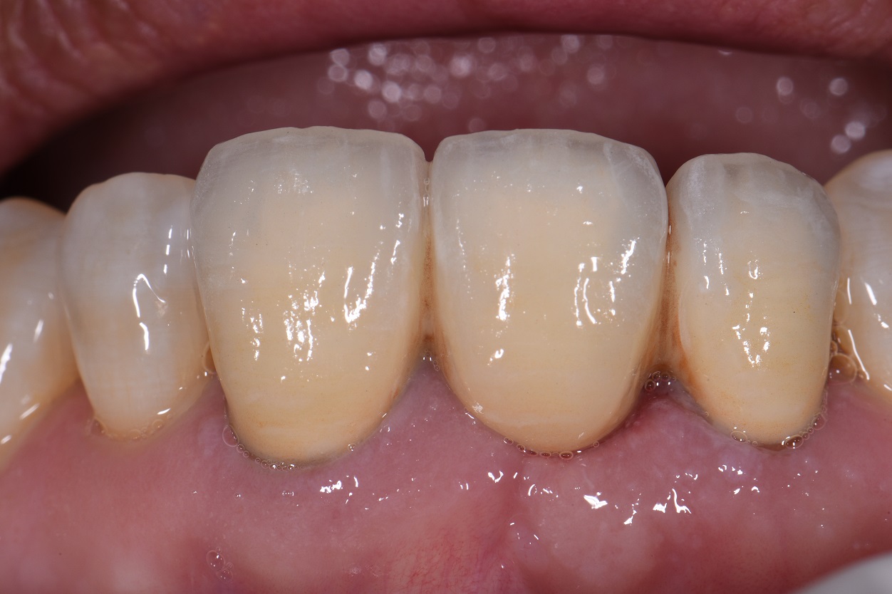 Ovate Pontic Site Development