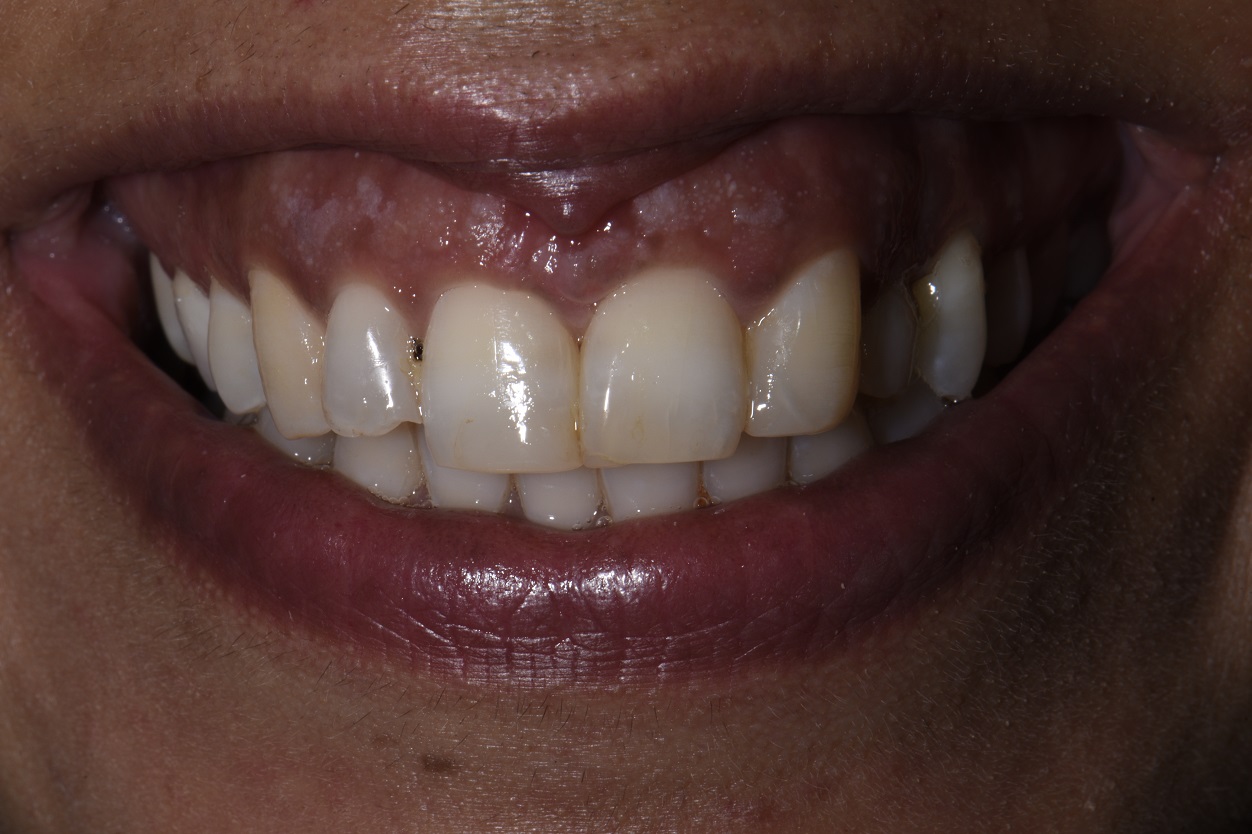 Smile Design Veneers and Implant Replacing Primary Canine