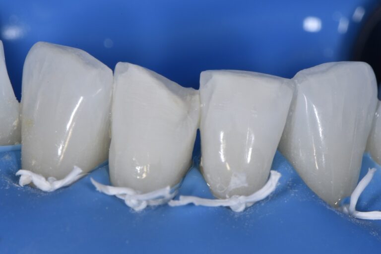 Instant orthodontics using Restorative Rotation