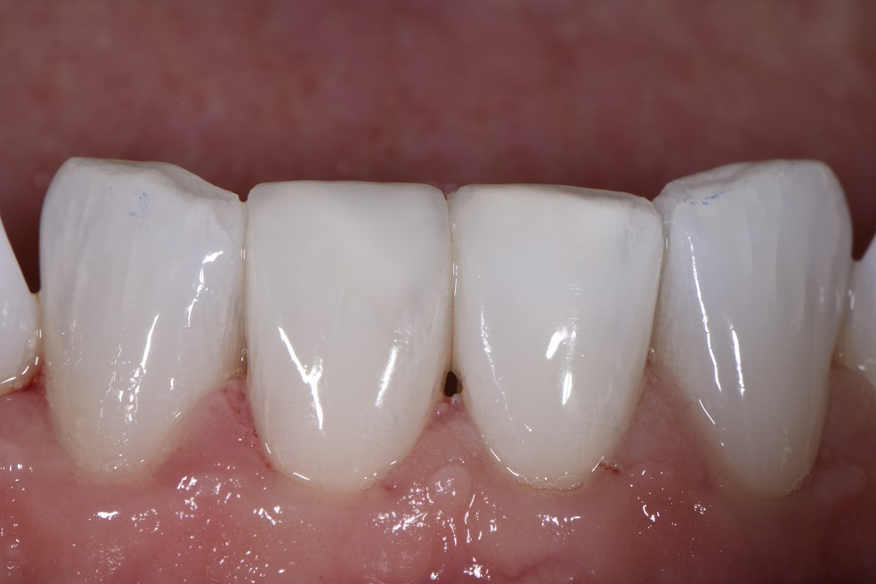 Instant orthodontics using Restorative Rotation