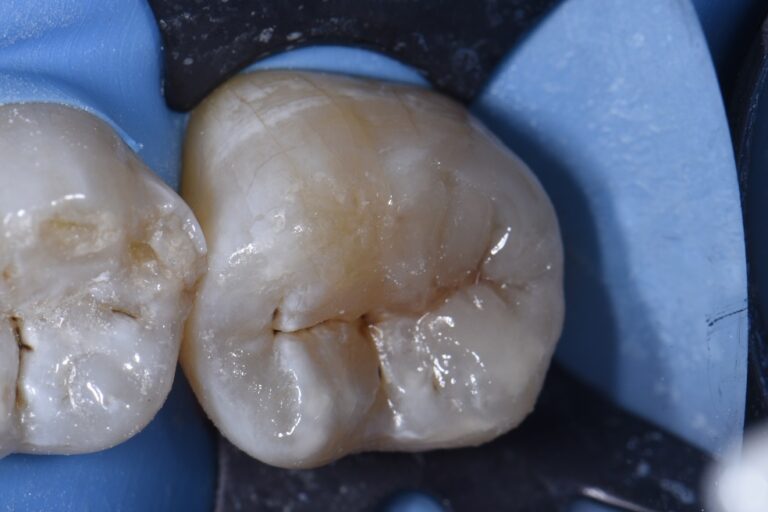 Tooth Crush Fractures Restored with Fluoridereleasing material