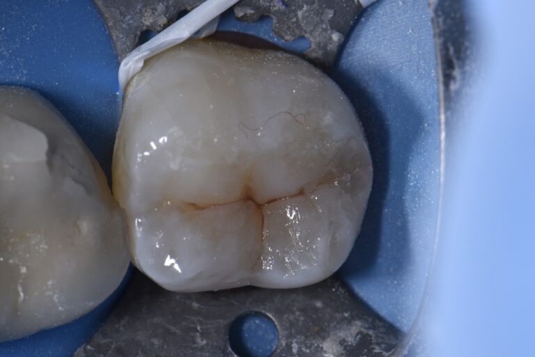 Chasing vertical hairline fractures