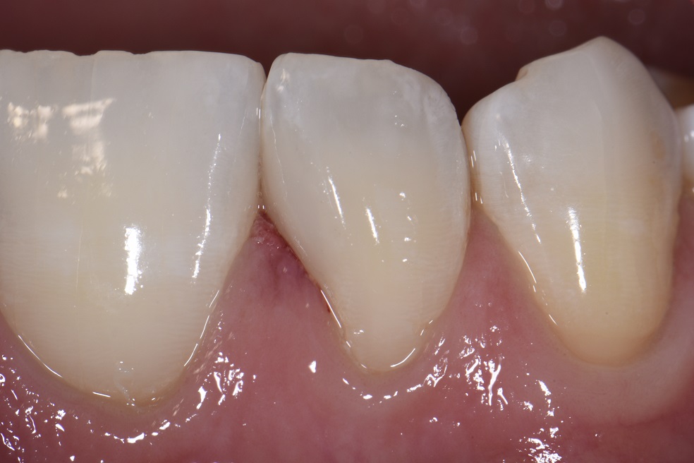 Restorative Addition to a Mesial Concavity in a Lateral Incisor