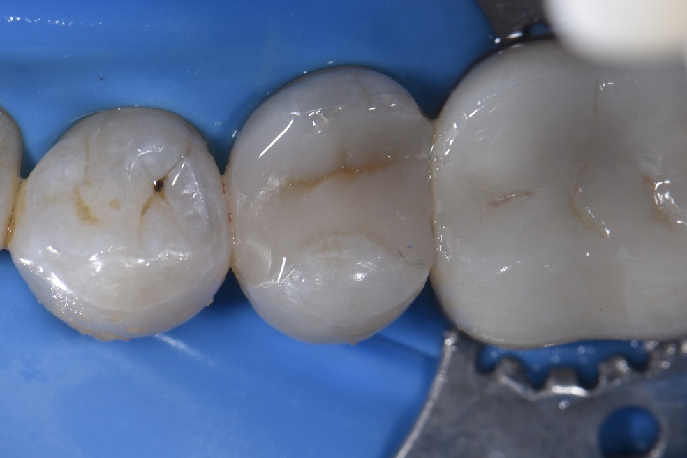 Bonding to old composite resin with new fillings