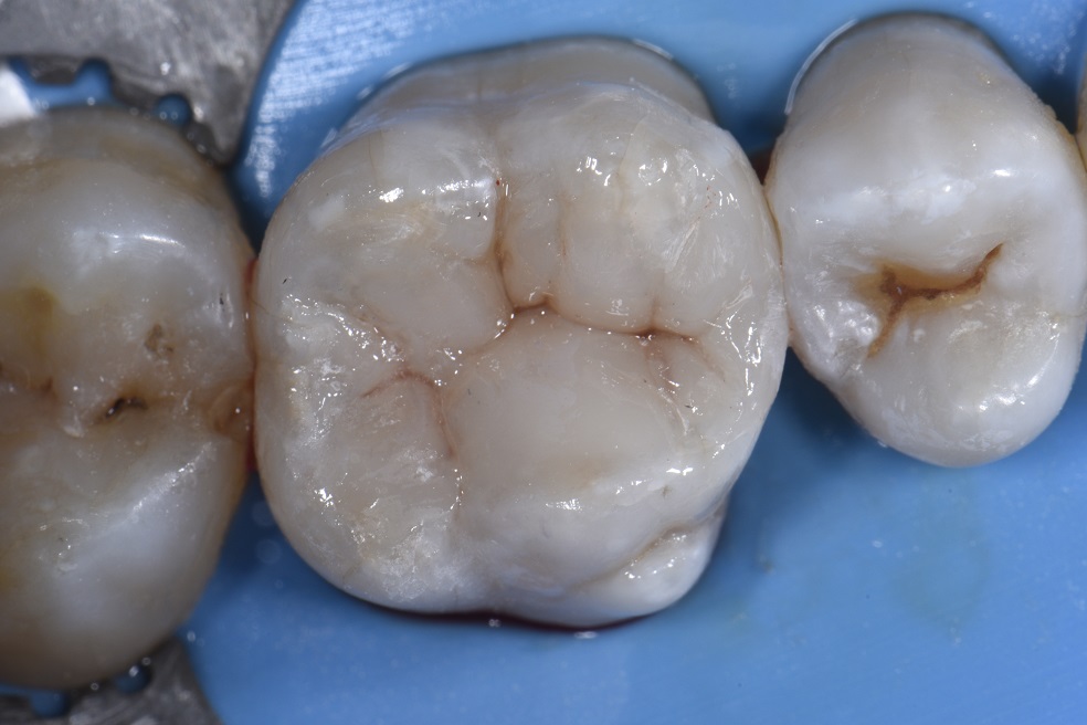 Sculpting Nature with Resin Composite