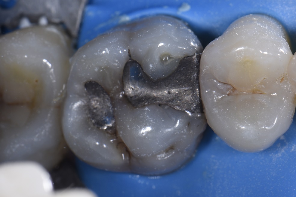 Replacing old amalgams with Beautifil II LS Giomer composite restorative