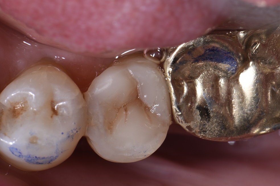 Composite Onlays for Conservation of Tooth Structure