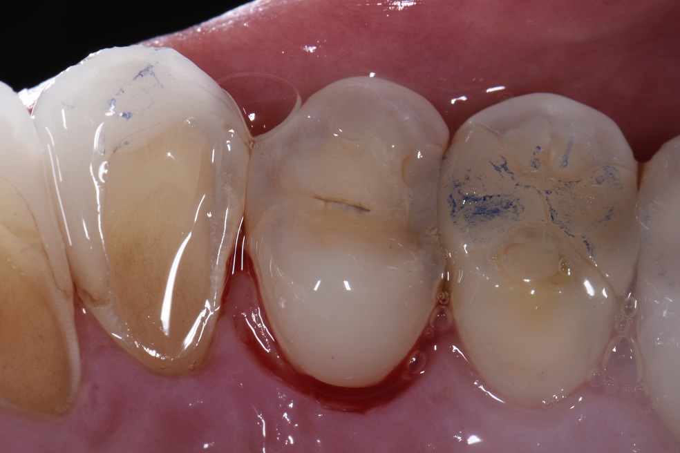 Acid Damage Reversed with a