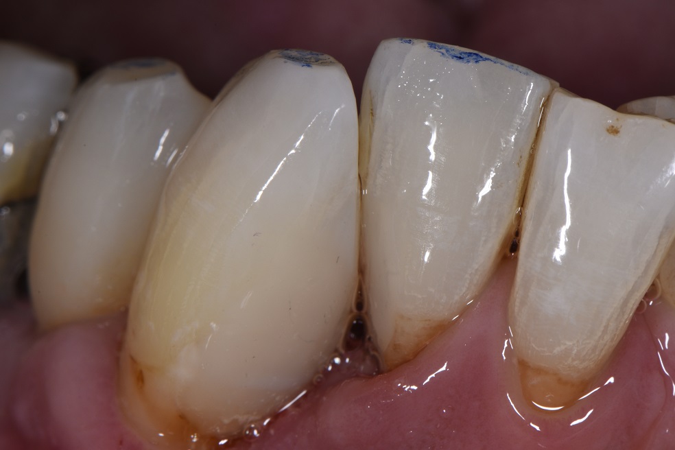 Subgingival root cavities restored with full isolation
