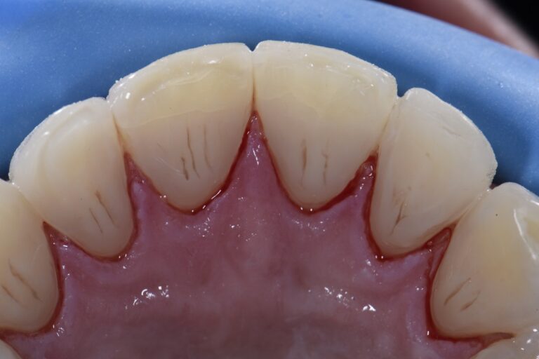 Acid Erosive Damage to Enamel Restored Invisibly