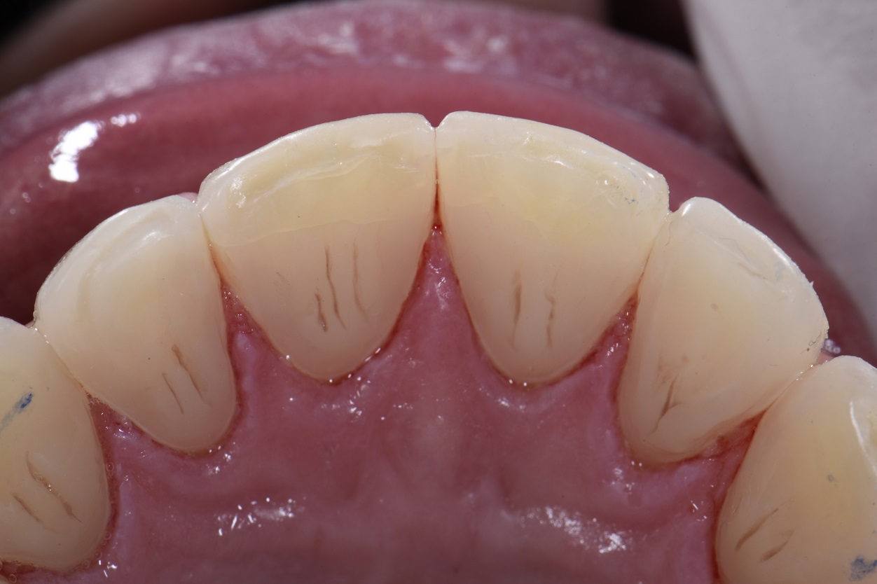 Acid Erosive Damage to Enamel Restored Invisibly