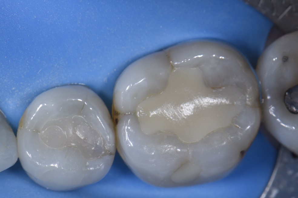 Removing Hairline Cracks in Teeth