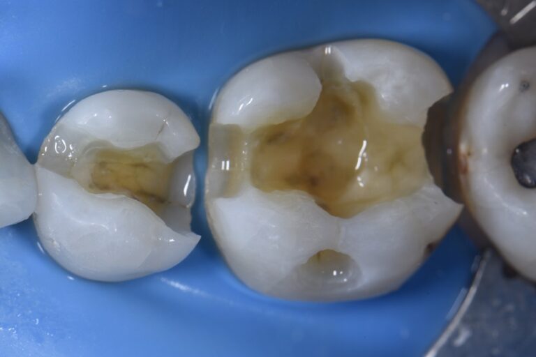 Removing Hairline Cracks in Teeth