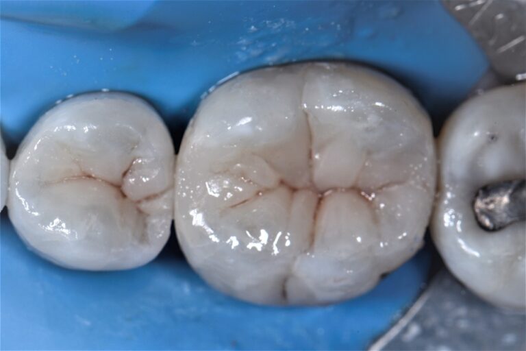 Removing Hairline Cracks in Teeth