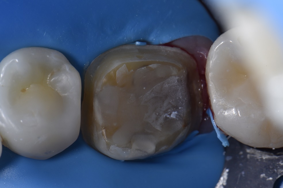 Blocking out Dark Stump Shades