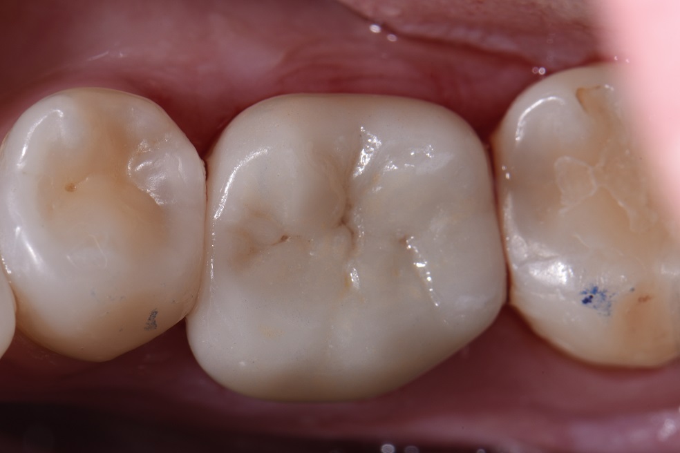 Blocking out Dark Stump Shades