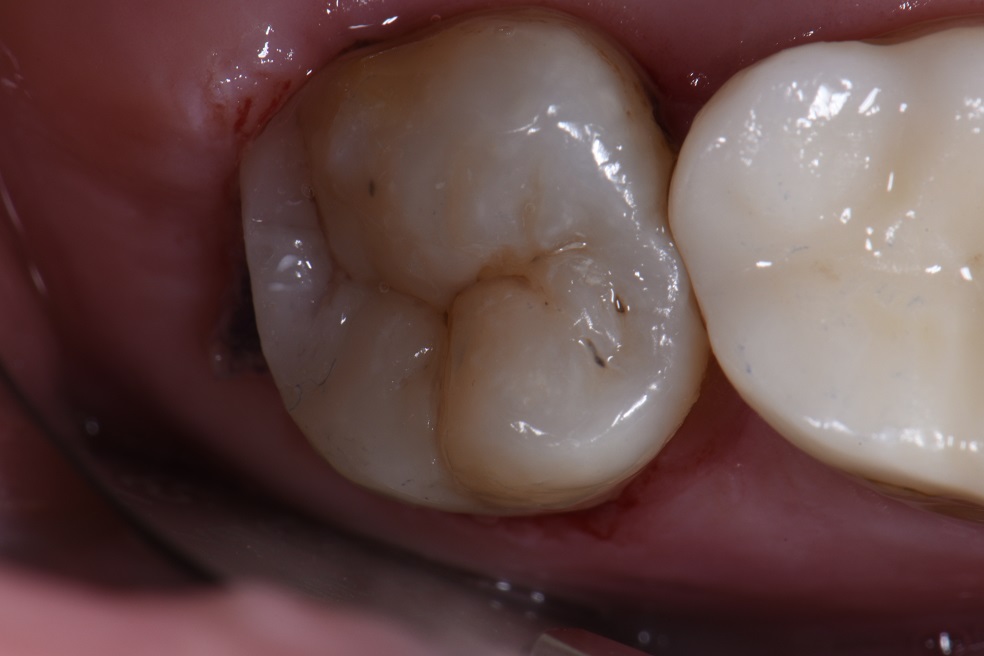 Rebuilding half a tooth with direct composite resin skulpting