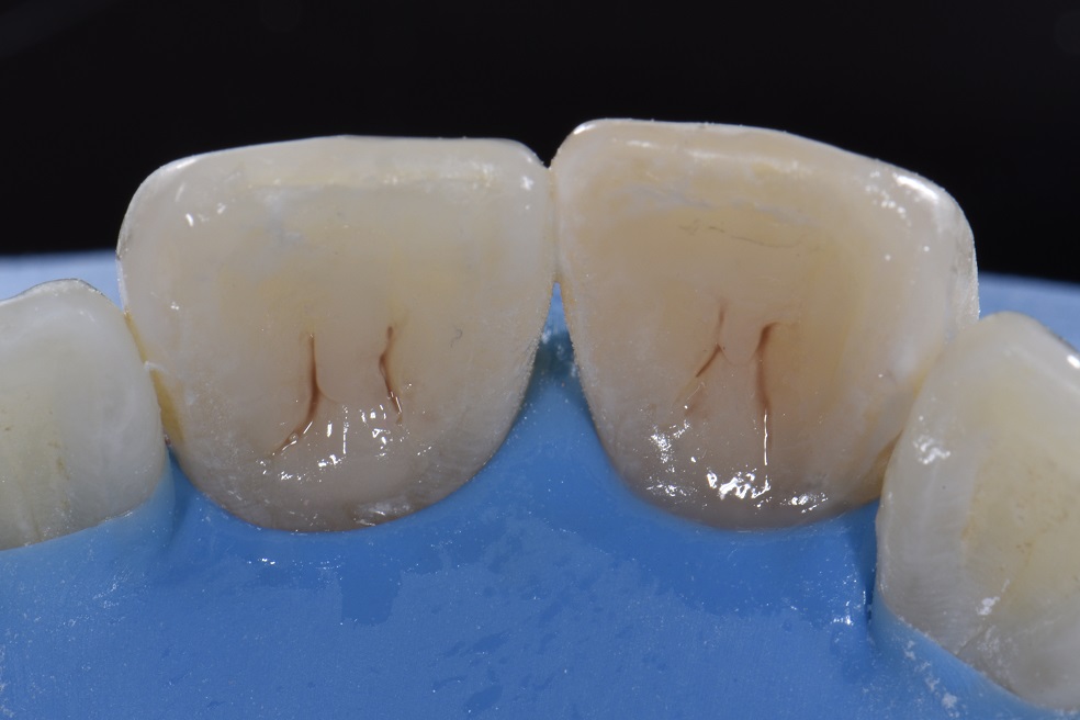 Root Canal Closure Filling Replacement