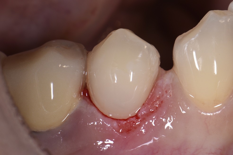 Class V restoration with GC Essentia U