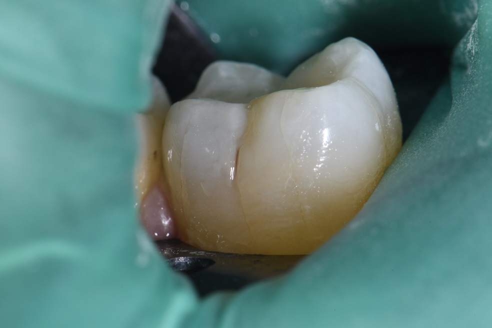 Microrestorative dentistry with skulpted composite resin
