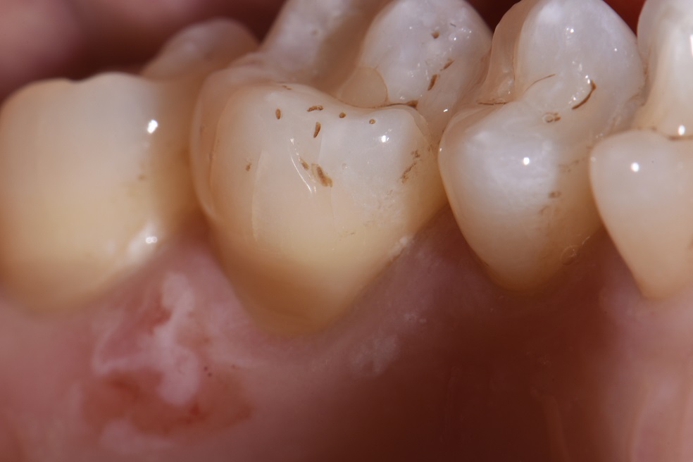 Palatal cervical abrasion lesions GC Essentia U