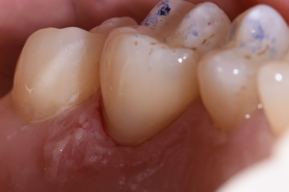 Palatal cervical abrasion lesions GC Essentia U