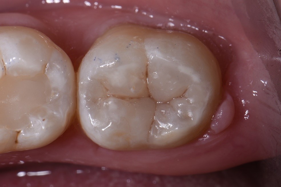 Selective fissure dissection in minimally invasive dentistry