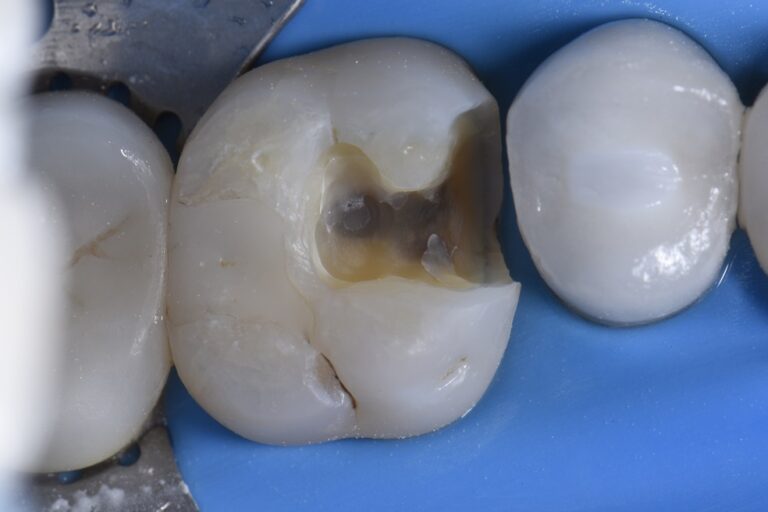 Skulpting Class II restorations using a prototype composite