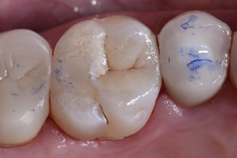Skulpting Class II restorations using a prototype composite