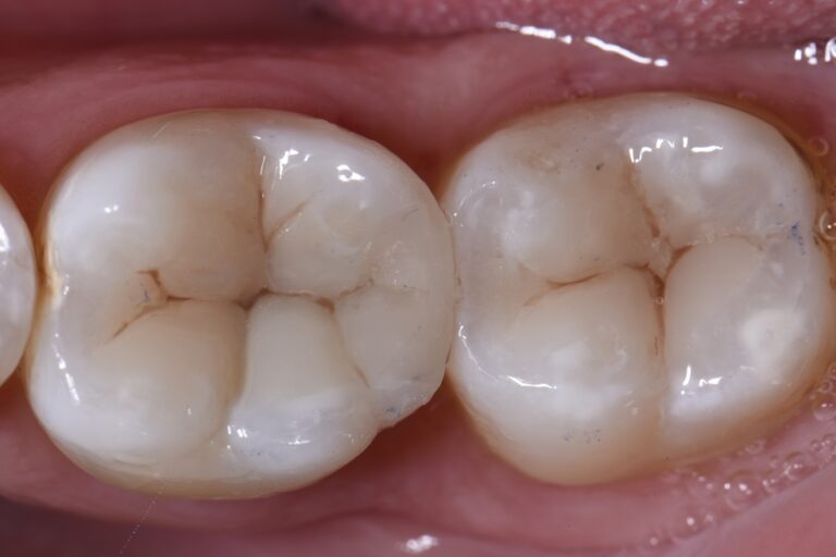 Occlusal adjustments in hyperfilled composite resin restorations