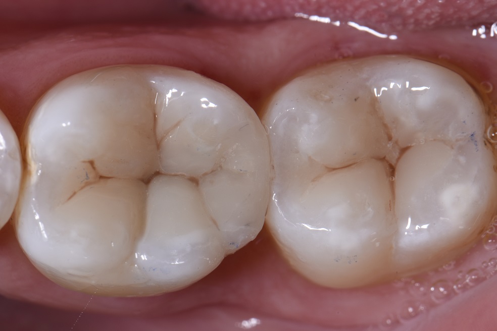 Occlusal adjustments in hyperfilled composite resin restorations