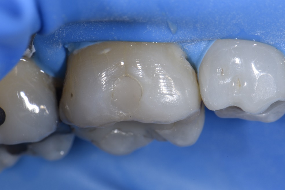 Reestablishing a strong hybrid layer