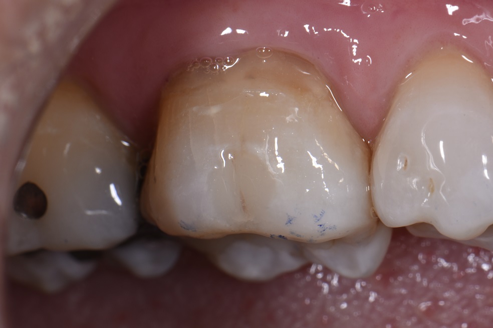 Reestablishing a strong hybrid layer