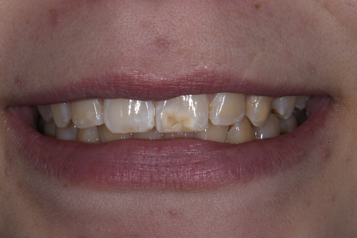 Resin infiltration and conservative composite layering