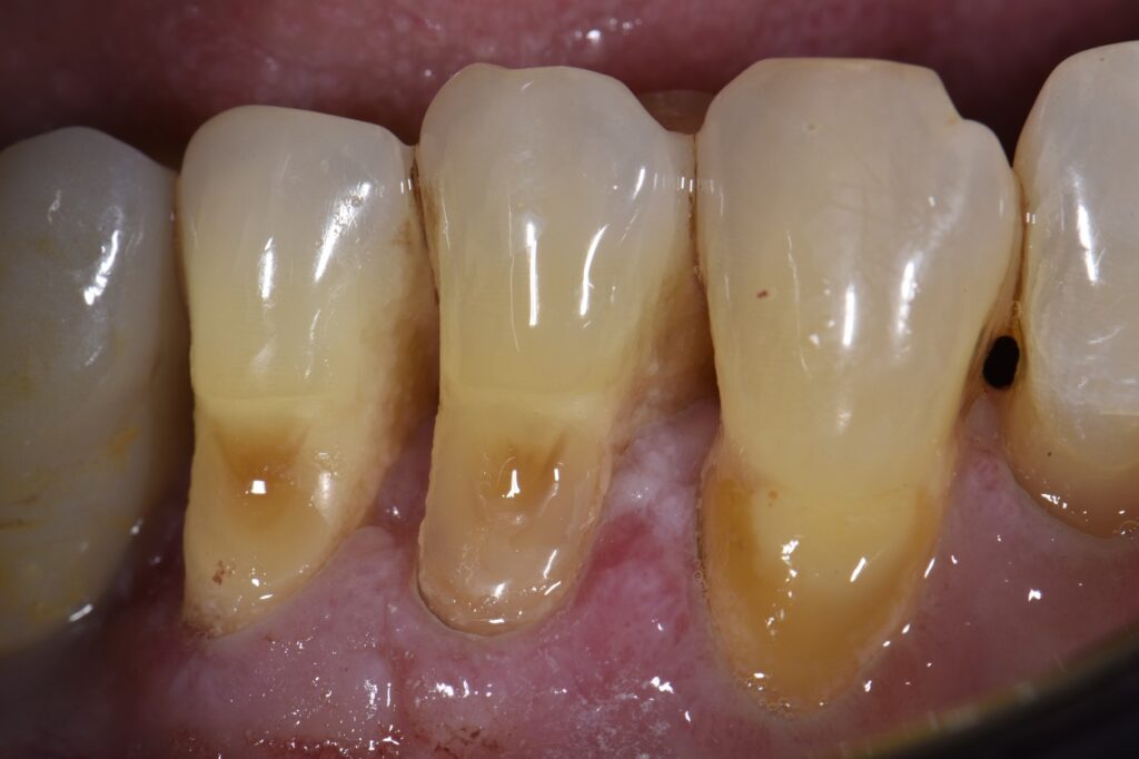 Root abrasion lesions restored and protected
