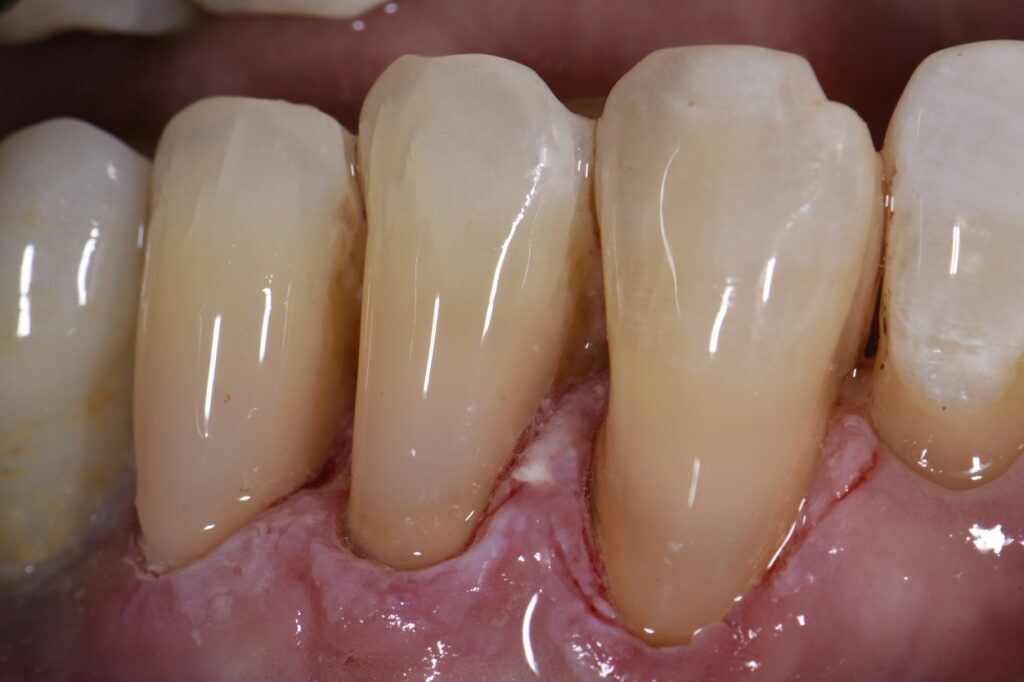 Root abrasion lesions restored and protected