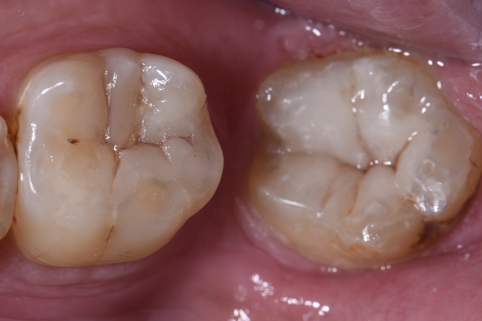 Restoring angled wisdom teeth cavities