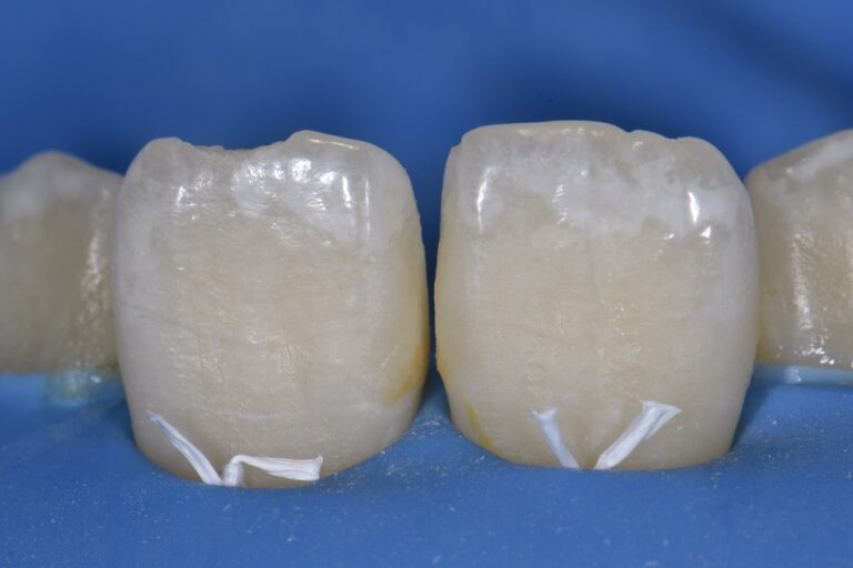 Resin infiltration with composite resin direct restoration combination