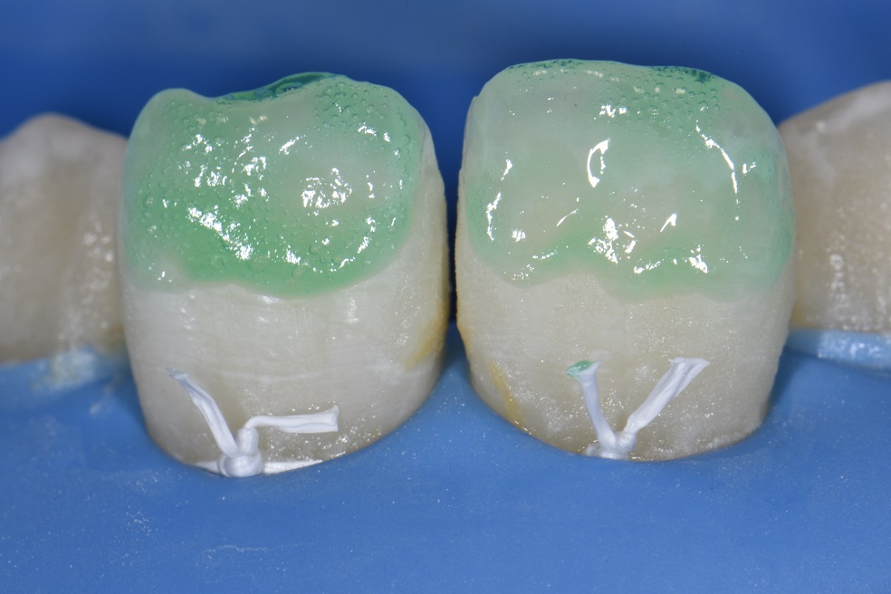 Resin infiltration with composite resin direct restoration combination