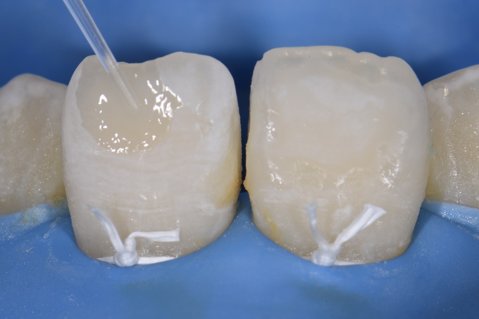 Resin infiltration with composite resin direct restoration combination