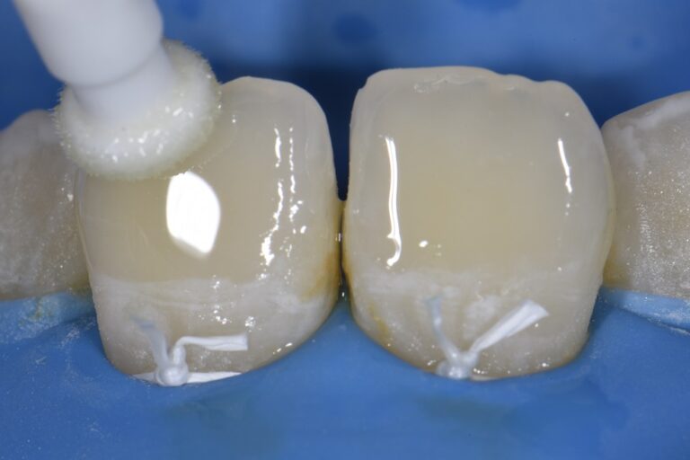 Resin infiltration with composite resin direct restoration combination