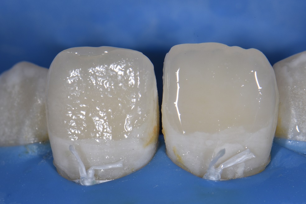 Resin infiltration with composite resin direct restoration combination