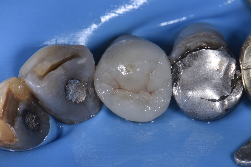 Deep Amalgam staining biomimetic composite